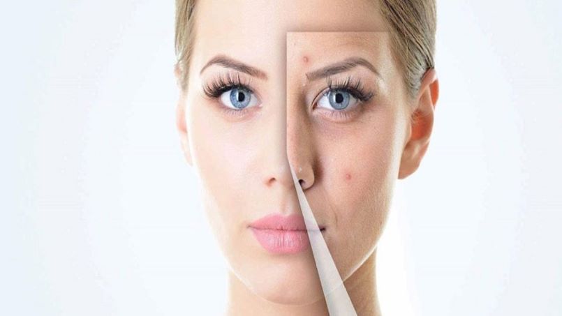 برای از بین بردن لکهای صورت چه باید کرد؟